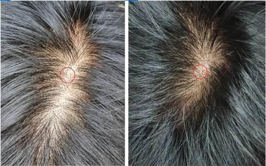 exosome hair restoration therapy London